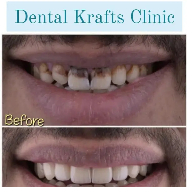 Dental Krafts