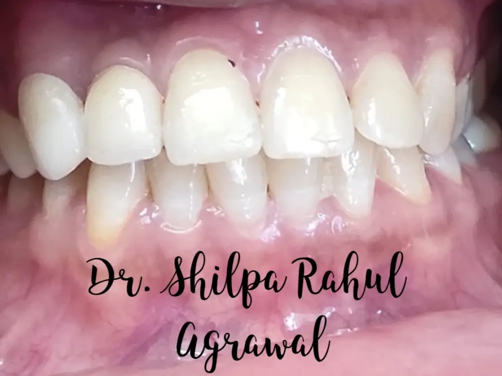 Anand Dental Clinic & implant centre Dr.Rahul Agrawal, Shahibag, Ahmedabad