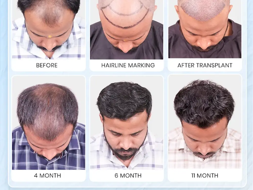 Hairfree & Hairgrow Clinic, Bopal, Ahmedabad
