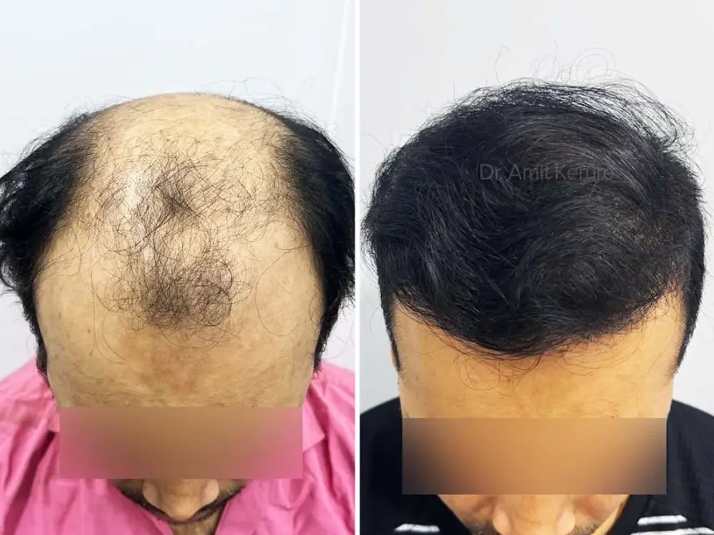 Hairsense Hair Transplant Clinic, Vashi, Navi Mumbai