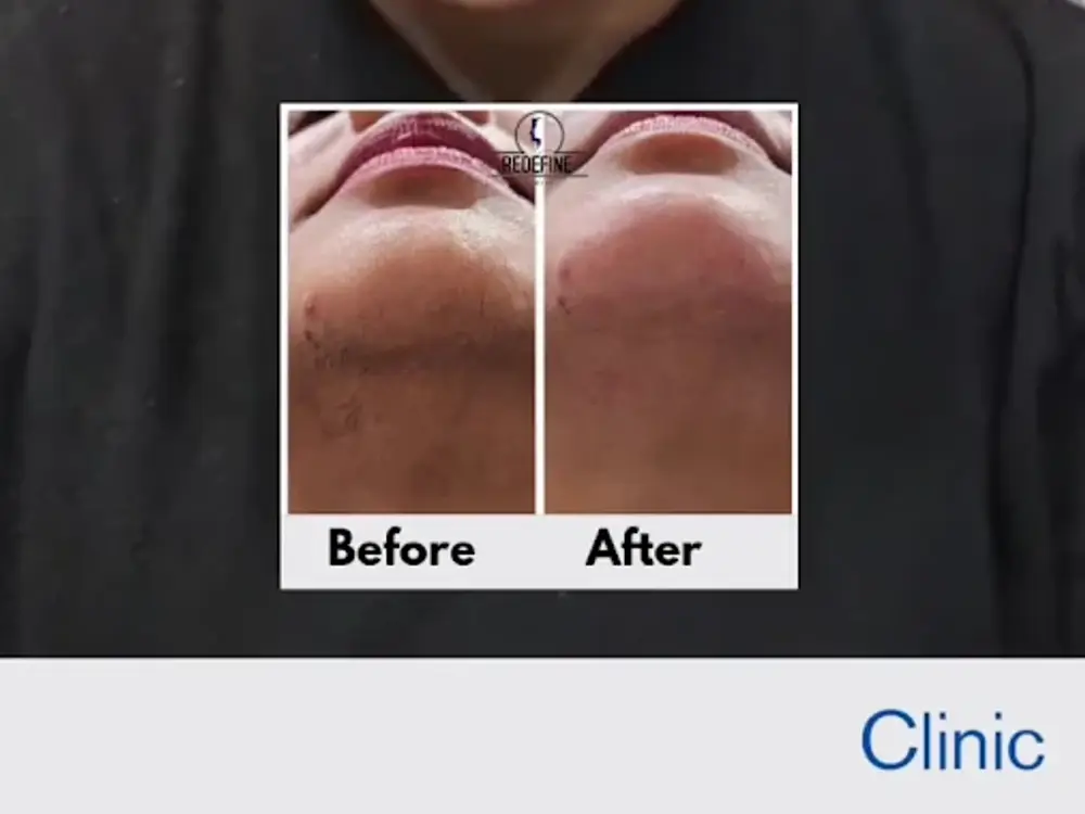 Redefine Beauty Skin,Laser &Hair Transplant Clinic, Shahberi, Noida