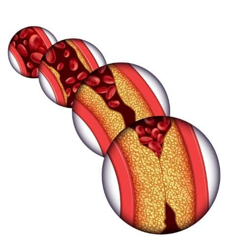 Brain- Stroke- cholestrol