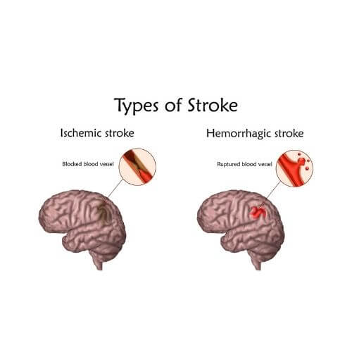 Types of  Brain stroke