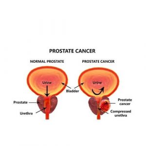 PSMA PET Scan- Is This A Way To Determine Prostate Cancer? - HealthFinder