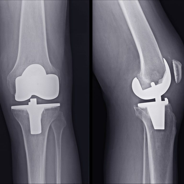 What Is Bilateral Knee Replacement Surgery? - HealthFinder