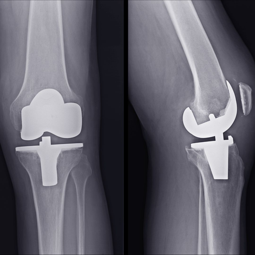 Bilateral knee Replacement in Chandigarh- HealthFinder