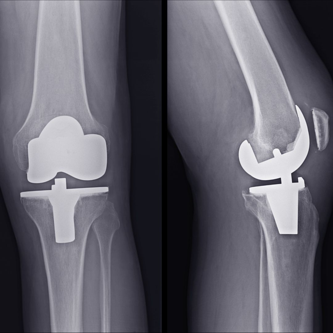 What Is Bilateral Knee Replacement Surgery HealthFinder